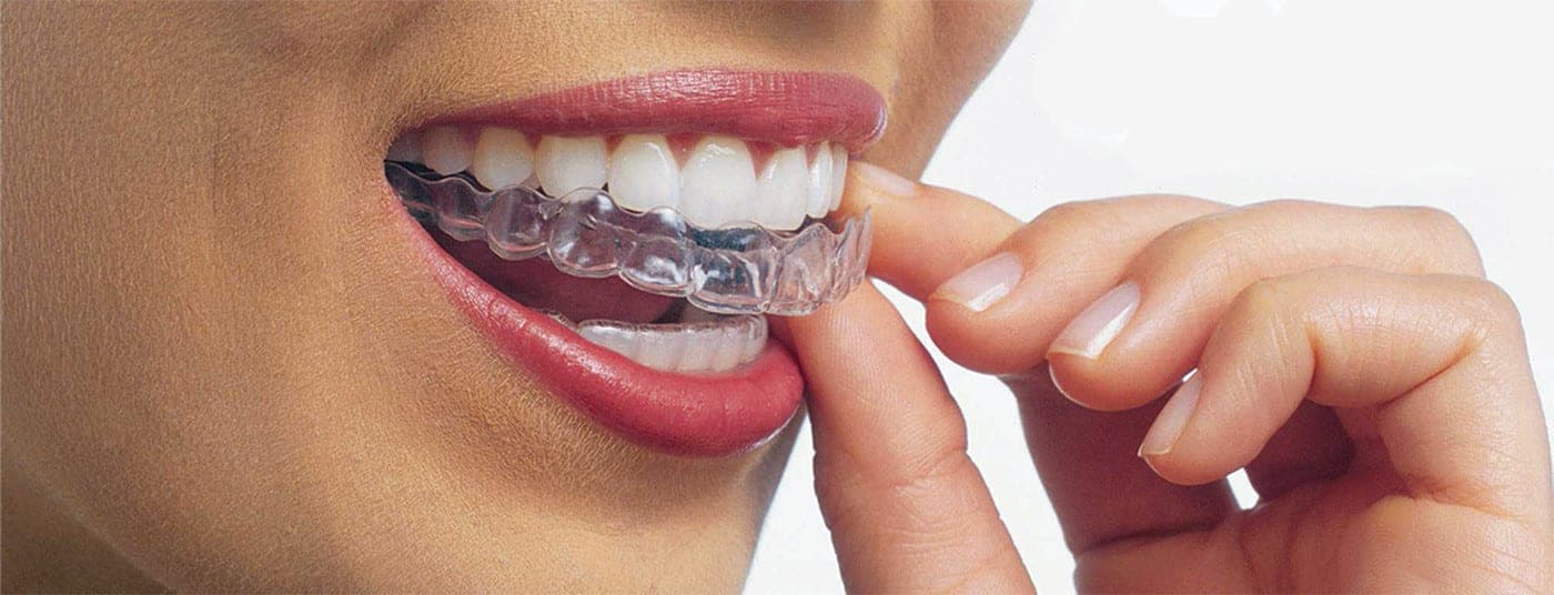 Clear aligners from Alexander Orthodontics
